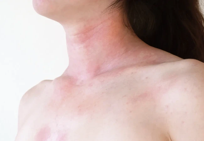 Click here to learn more about radiotherapy-induced dermatitis