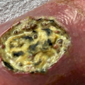 Infected wounds before and after treatment. View our case reports to learn more.