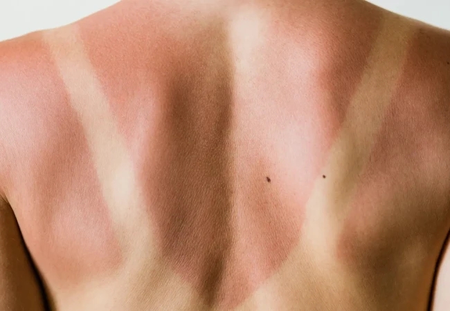 Click here to learn more about sunburns