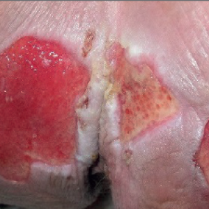 Moister Associated Skin Damage