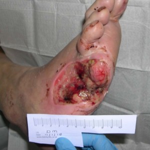 Diabetic foot ulcers