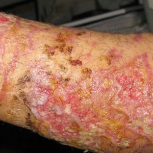 Ustioni superficiali e profonde a spessore parziale