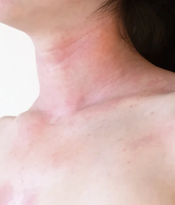 Image of a skin damage from radiotherapy. Click to learn more about radiotherapy-induced dermatitis.