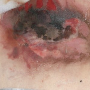 Pressure ulcer before and after treatment. View our case reports to learn more.