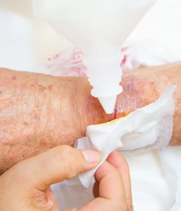 Picture of a wound in an elderly patient. Click to learn more about acute & chronic wound healing.
