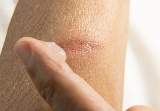 Click here to learn more about how to treat damaged skin
