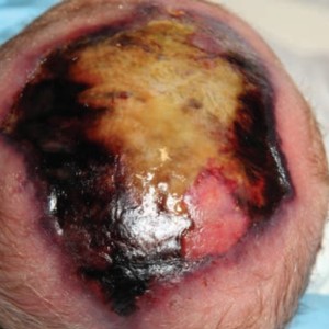 Neonates and paediatrics wounds before and after treatment. View our case reports.