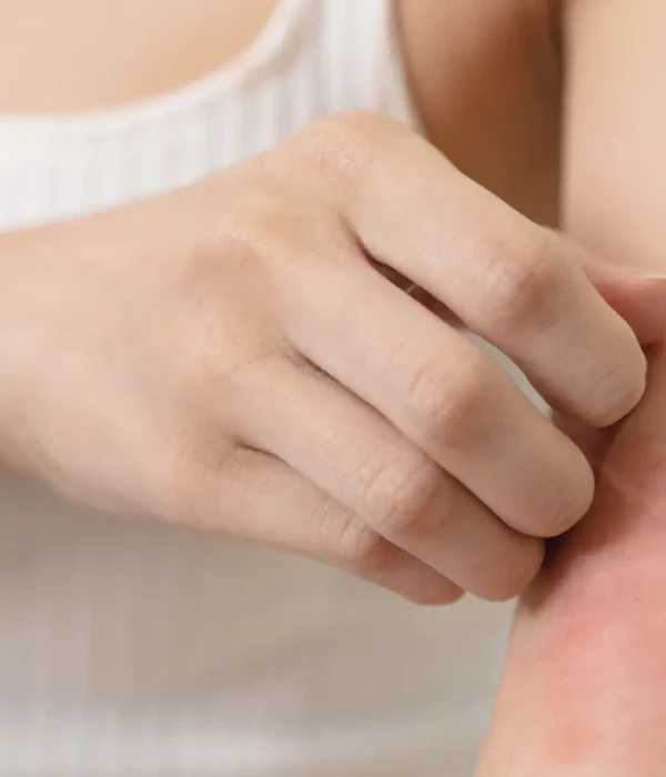 Picture of itchy, red skin. Click to learn more about our solution for acute and chronic itch.